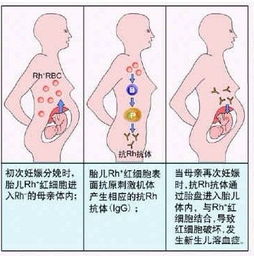 血型配对夫妻新生儿溶血