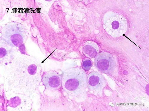 核偏位细胞就是印戒细胞